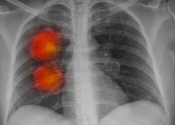 New artificial intelligence tool can accurately identify cancer