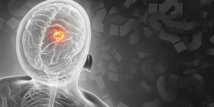 AI model can help determine where a patient’s cancer arose